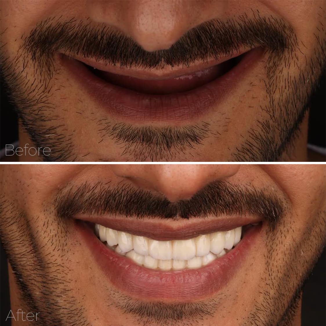 حالة تجميل أسنان 1 - زراعة الأسنان